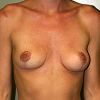Breast Lift for Asymmetry Correction