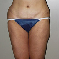 Liposuction Abdomen/Thighs