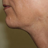 Liposuction Jowl and Neck