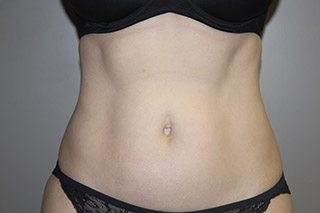 Front view of Aesthetic Surgery sample patient 1 after receiving SculpSure treatment on flanks and abdomen.