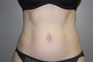 SculpSure-flanks-ab-2 - Keith Denkler M.D.