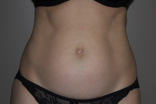 Front view of Aesthetic Surgery sample patient 1 before receiving SculpSure treatment on flanks and abdomen.