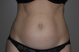 SculpSure-flanks-ab-2 - Keith Denkler M.D.