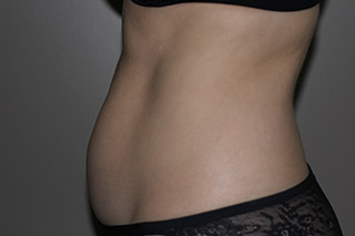 Side view of Aesthetic Surgery sample patient 1 before receiving SculpSure treatment on flanks and abdomen.