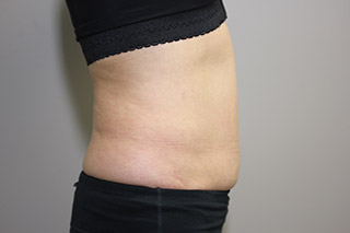 Side view of Aesthetic Surgery sample patient 2 before receiving SculpSure treatment on flanks and abdomen.<br />
