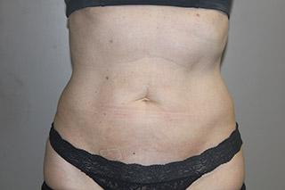 Front view of Aesthetic Surgery sample patient 3 after receiving SculpSure treatment on flanks and abdomen.