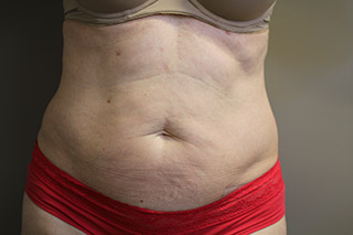 Front view of Aesthetic Surgery sample patient 3 before receiving SculpSure treatment on flanks and abdomen.