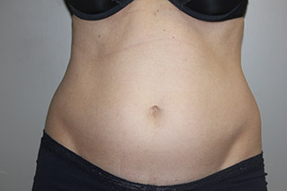 Front view of Aesthetic Surgery sample patient 4 before receiving SculpSure treatment on flanks and abdomen.