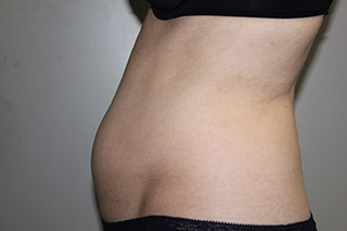 Side view of Aesthetic Surgery sample patient 4 before receiving SculpSure treatment on flanks and abdomen.