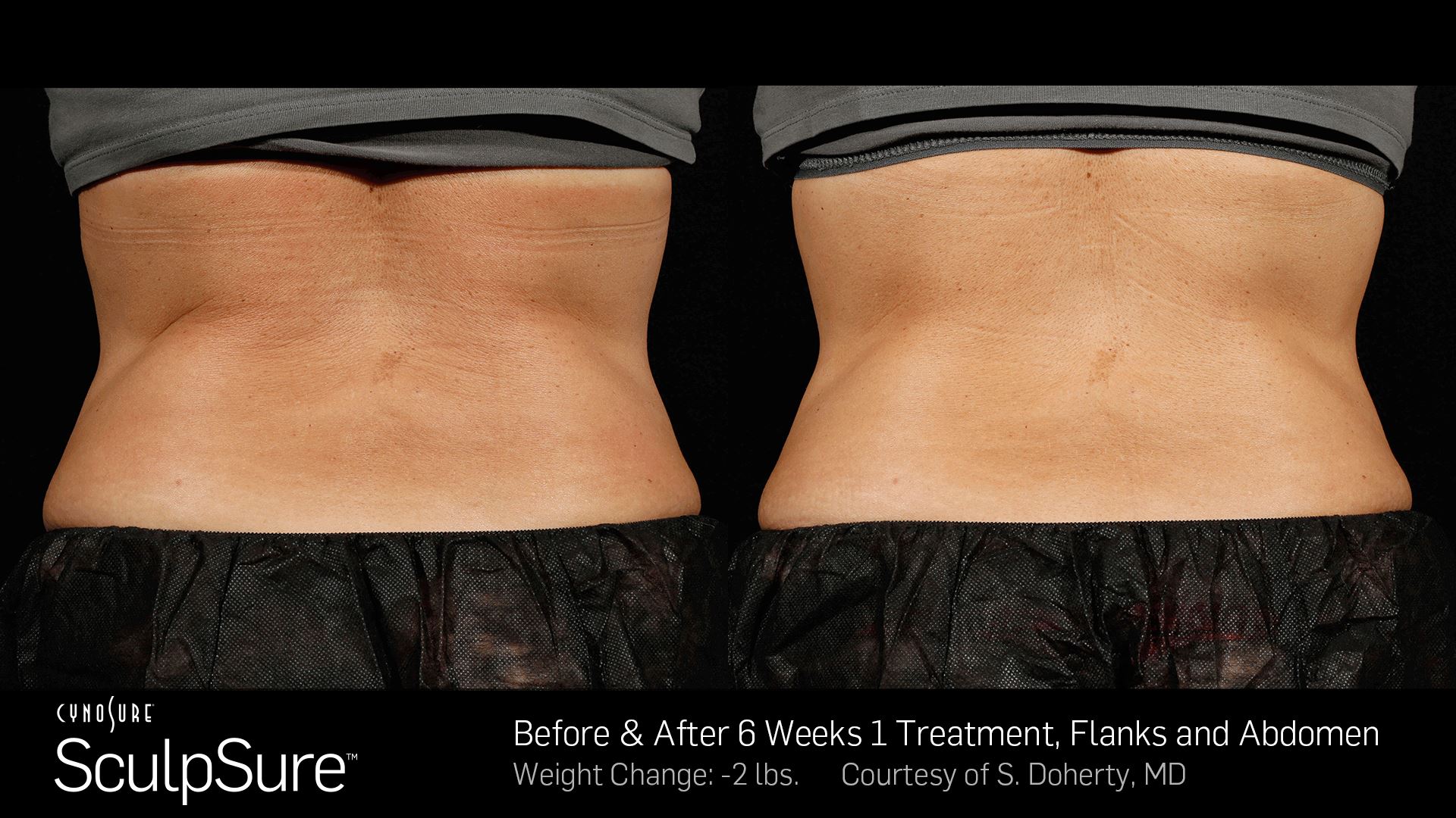 SculpSure-flanks-ab-2 - Keith Denkler M.D., flanks 