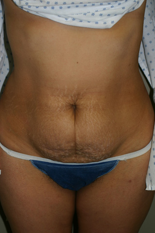 Front view of Aesthetic Surgery patient before abdominoplasty.