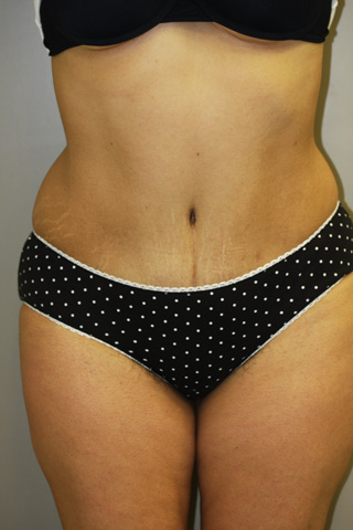 Front view of Aesthetic Surgery patient after abdominoplasty.