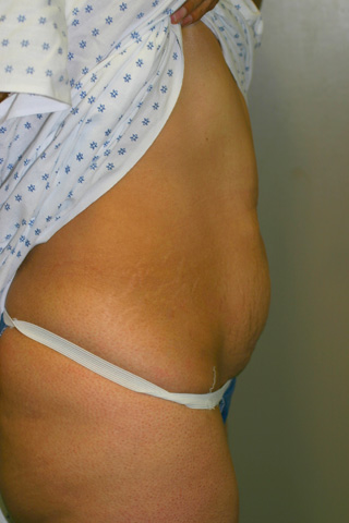 Side view of Aesthetic Surgery patient before abdominoplasty.