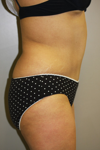 Side view of Aesthetic Surgery patient after abdominoplasty.