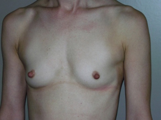 Sample patient number 1 before breast augmentation surgery