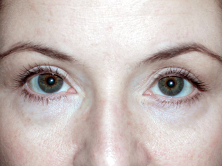 Front view of Aesthetic Surgery patient after eye lift surgery. After surgery eyes open wider and eyelids no longer droop.