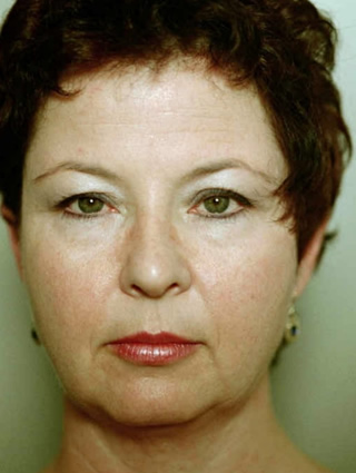 Facelift patient before surgery- front view, full face