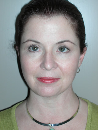 Aesthetic surgery patient looking younger after facelift surgery- front view, full face