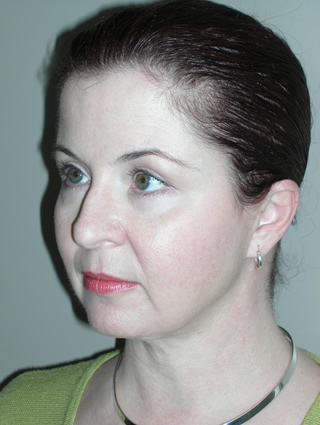 Aesthetic surgery patient after facelift surgery- profile view, side of face