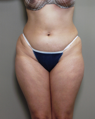 Front view of Aesthetic Surgery sample patient number 1 before liposuction of abdomen and thighs.