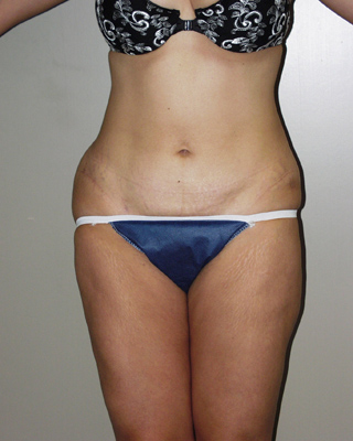Front view of Aesthetic Surgery sample patient number 1 after liposuction of abdomen and thighs.