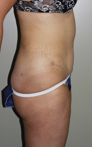 Side view of Aesthetic Surgery sample patient number 1 after liposuction of abdomen and thighs.