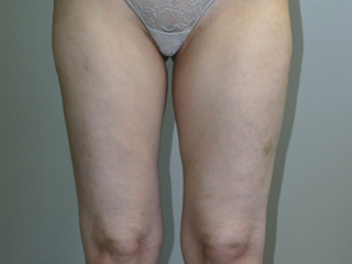 Front view of Aesthetic Surgery sample patient number 2 after liposuction of abdomen and thighs.