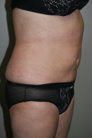 Side view of Aesthetic Surgery patient number 3 after liposuction of abdomen.