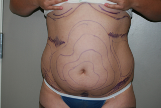 Front view of Aesthetic Surgery sample patient number 1 before liposuction of abdomen.