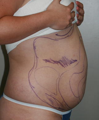 Side view of Aesthetic Surgery patient number 1 before liposuction of abdomen.