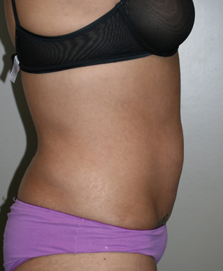 Side view of Aesthetic Surgery patient number 1 after liposuction of abdomen.
