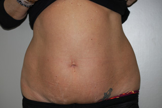 Front view of Aesthetic Surgery sample patient number 3 before liposuction of abdomen.