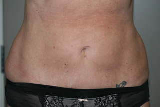 Front view of Aesthetic Surgery patient number 3 after liposuction of abdomen.