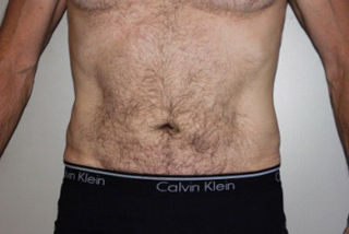 Front view of Aesthetic Surgery patient number 4 after liposuction of abdomen.