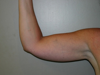 Sample patient number 1 before liposuction of the upper arm.