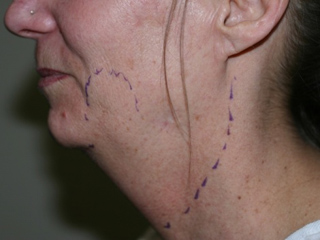 Side profile view of Aesthetic Surgery patient before liposuction of jowl and neck.