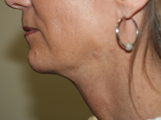 Side profile view of Aesthetic Surgery patient after liposuction of jowl and neck.