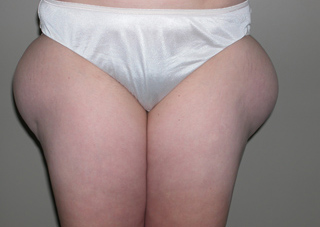 Front view of Aesthetic Surgery patient before liposuction of outer thighs.
