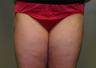 Front view of Aesthetic Surgery patient after liposuction of outer thighs.