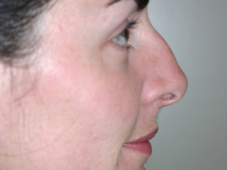 Side view of rhinoplasty (nose job) patient before surgery. 