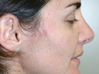 Side view of Aesthetic Surgery patient after rhinoplasty. Bridge of the nose is smooth, free of any bumps.