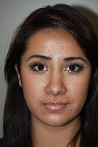 Front view of Aesthetic Surgery patient after rhinoplasty. Nose appears smaller and the shape of the nose is improved.