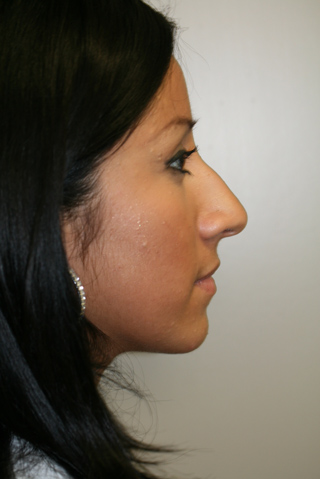 Side profile view of Aesthetic Surgery patient before rhinoplasty (nose job).