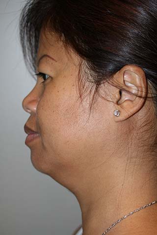Side profile view of Aesthetic Surgery patient number 1 before Smartlipo treatment of neck.