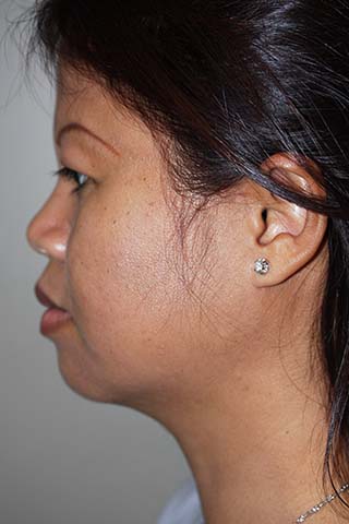 Side profile view of Aesthetic Surgery patient number 1 after Smartlipo treatment of neck.