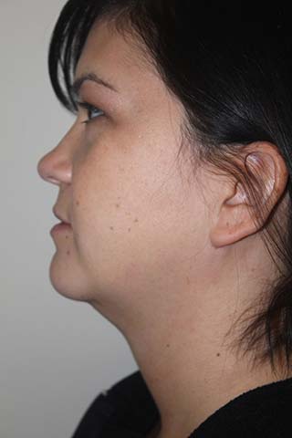 Side profile view of Aesthetic Surgery patient number 2 before Smartlipo treatment of neck.