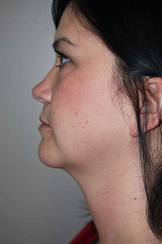 Side profile view of Aesthetic Surgery patient number 2 after Smartlipo treatment of neck.