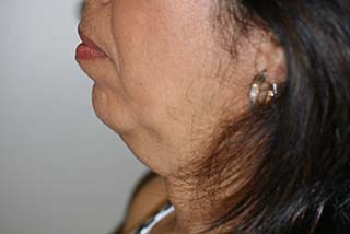 Side profile view of Aesthetic Surgery patient number 3 before Smartlipo treatment of neck.