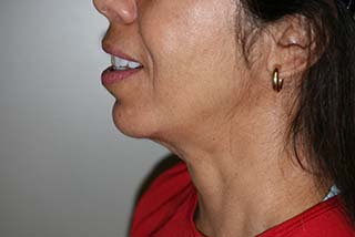 Side profile view of Aesthetic Surgery patient number 3 after Smartlipo treatment of neck.