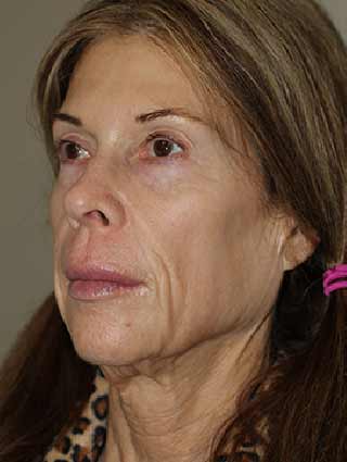 Facelift patient before surgery- profile view, side of face